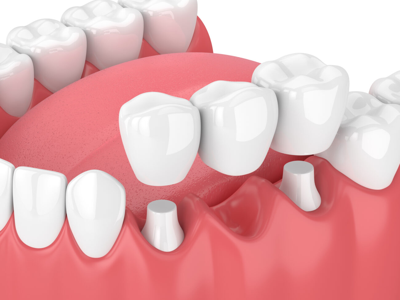 dental bridge boulder co