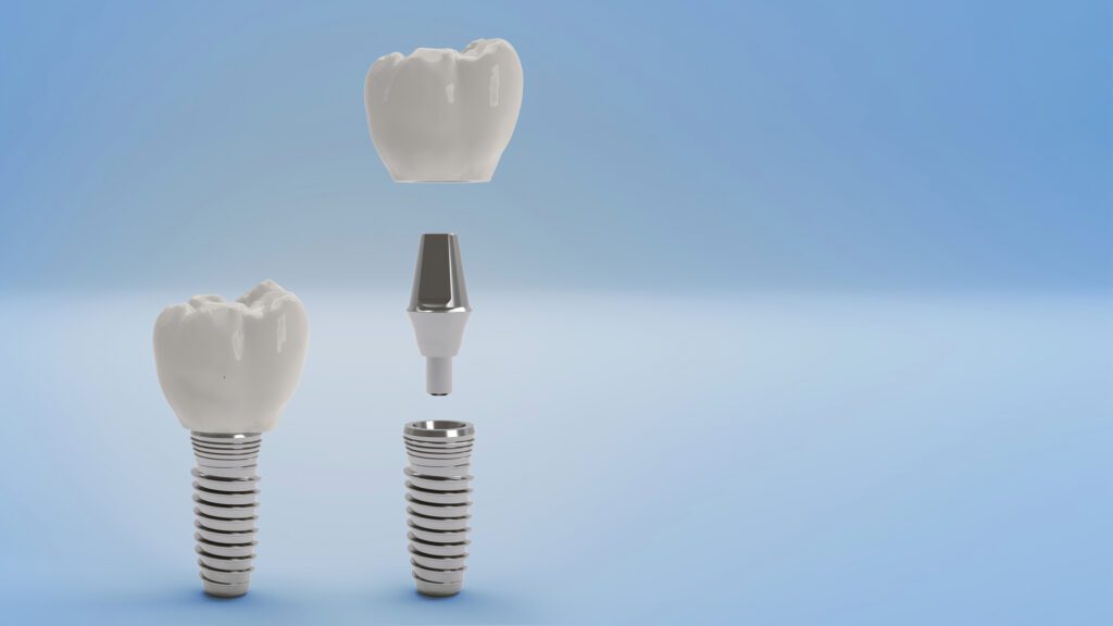 Dental Implants in Boulder, Colorado