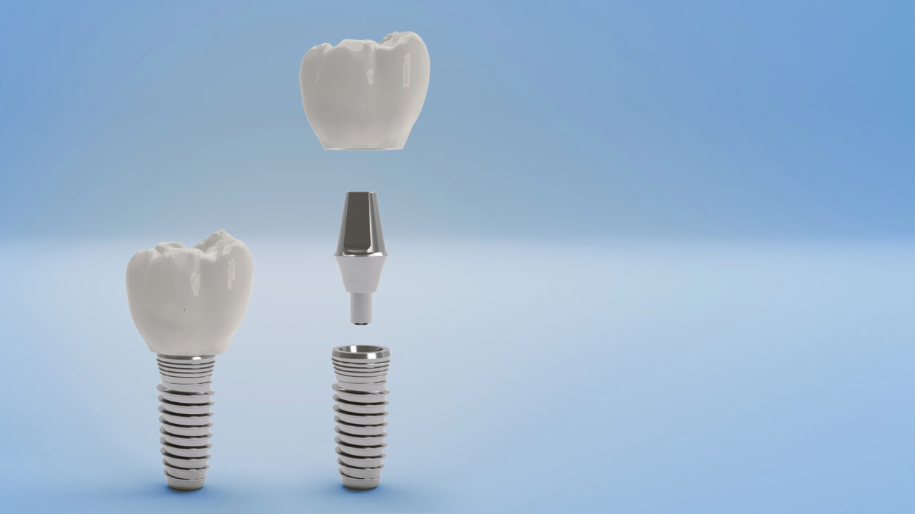 Dental Implants Boulder CO Single Tooth Implant Longmont