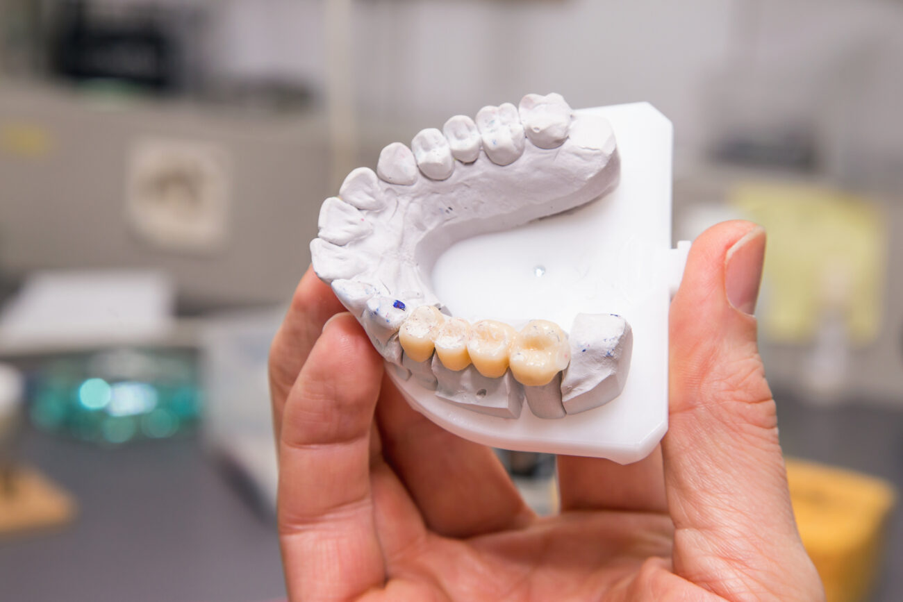 Dental Bridge Treatment in Boulder, Colorado