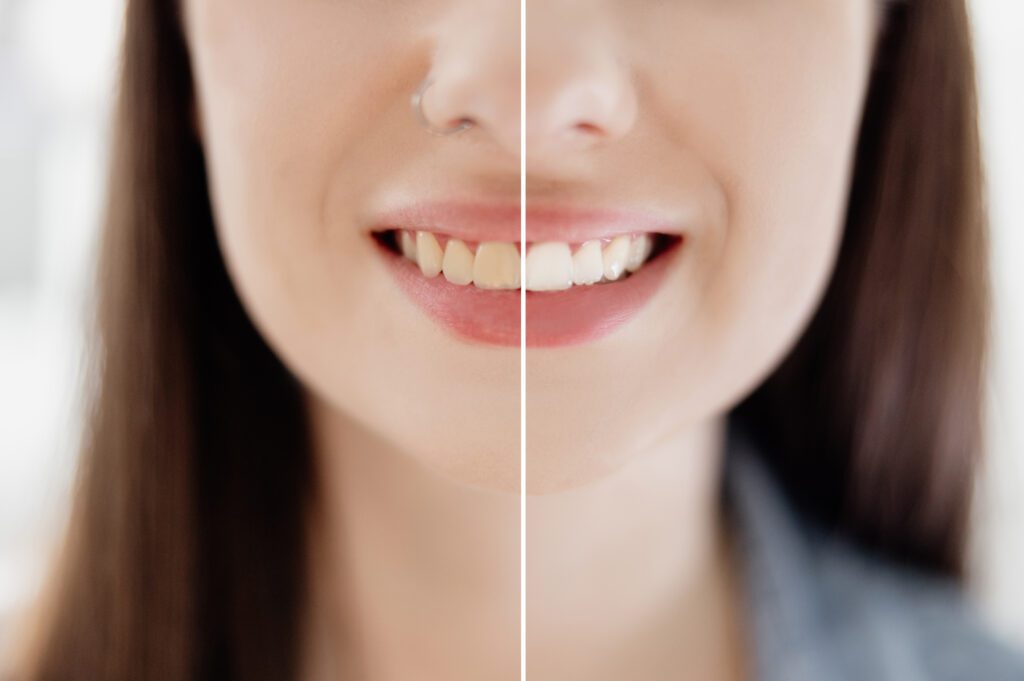 Teeth Whitening in Boulder, Colorado