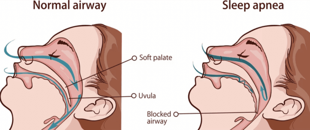 comparison of normal airway vs airway with sleep apnea dentists in Boulder Colorado