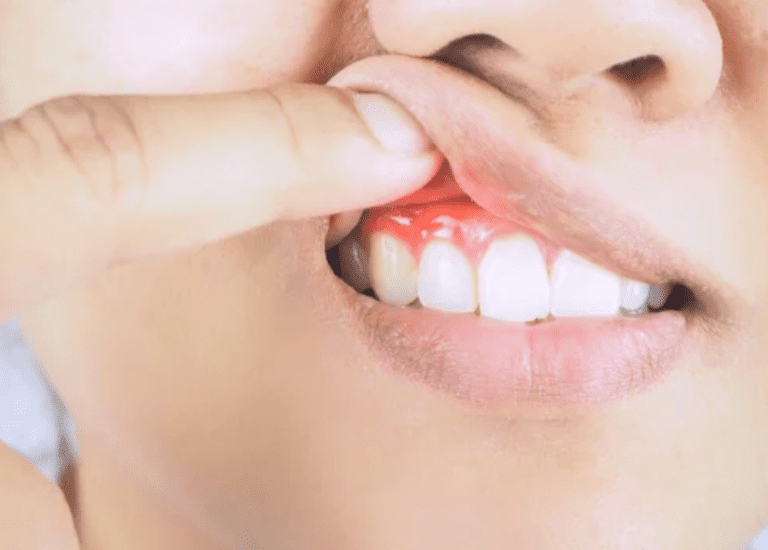 Image of finger holding up lips revealing red, swollen gums gum disease dentist in Boulder Colorado