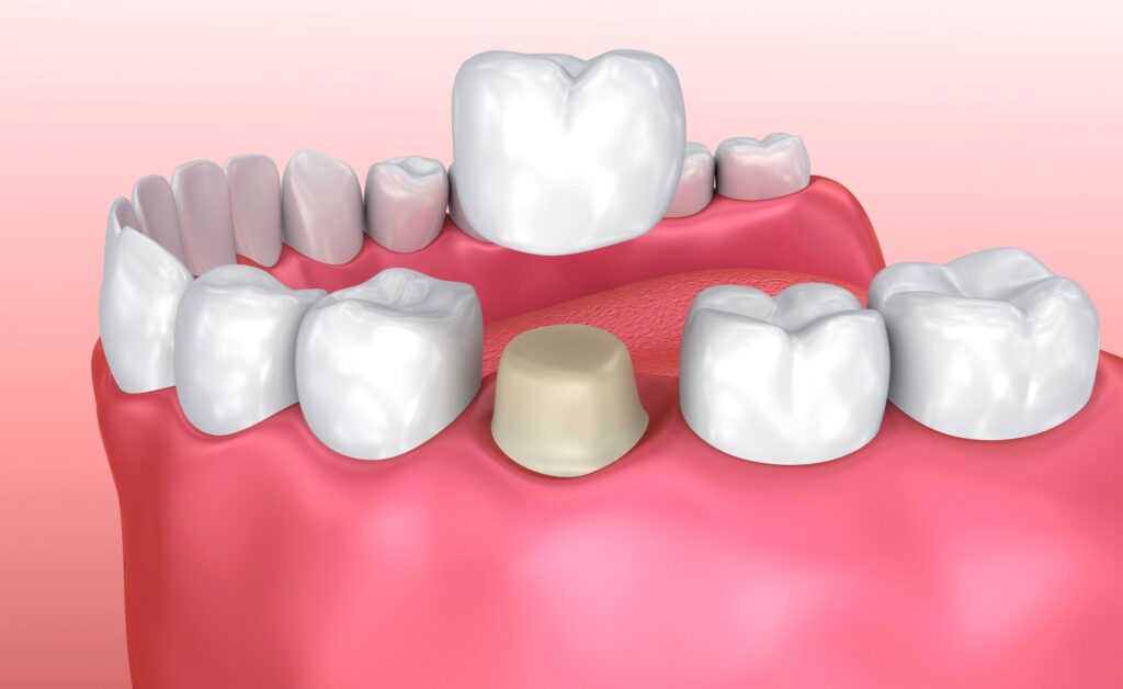 3D image of crown installation process restorative dentistry Boulder Colorado