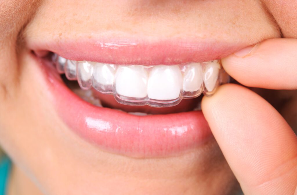 Crooked Teeth in Boulder CO