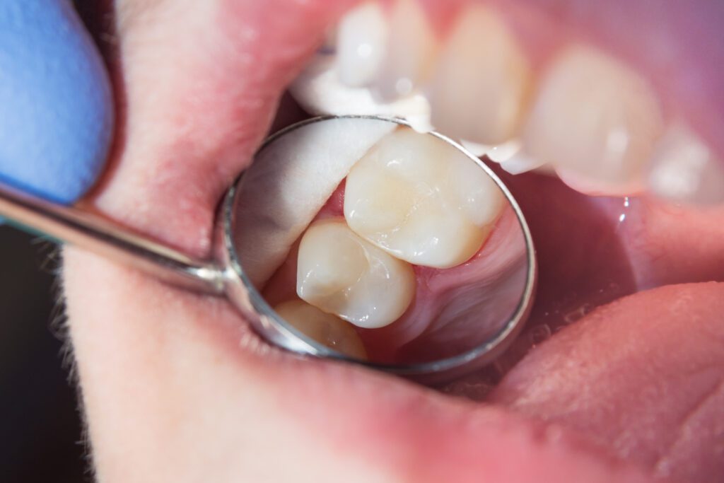 Tooth Cavity in Boulder CO