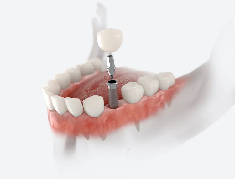 What’s It Like to Get a Dental Implant? in Boulder, CO